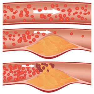 danni apparato cardiovascolare