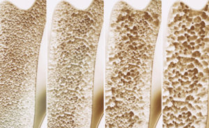 calcio magnesio zinco osteoporosi