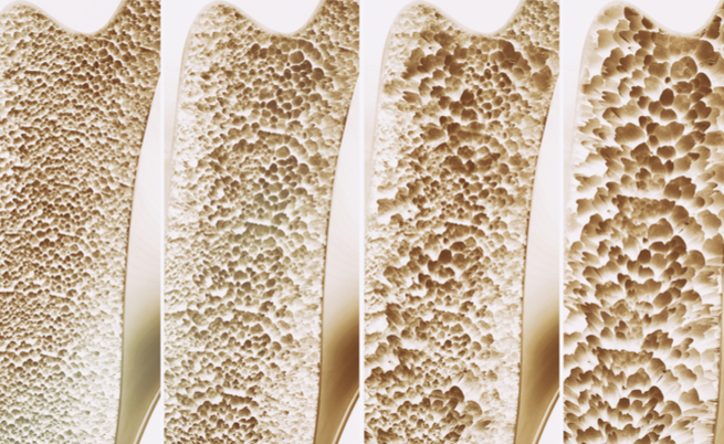 calcio magnesio zinco osteoporosi